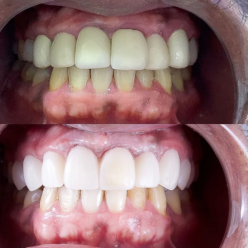 Veneers case by Dr. Kaísa Ströher — before and after 1