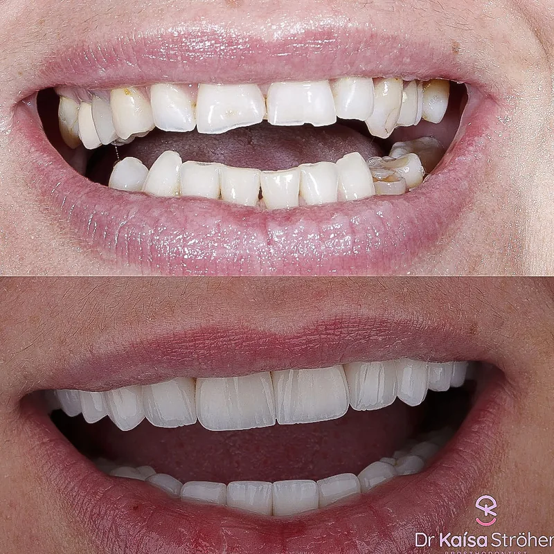 Veneers case by Dr. Kaísa Ströher — before and after 4