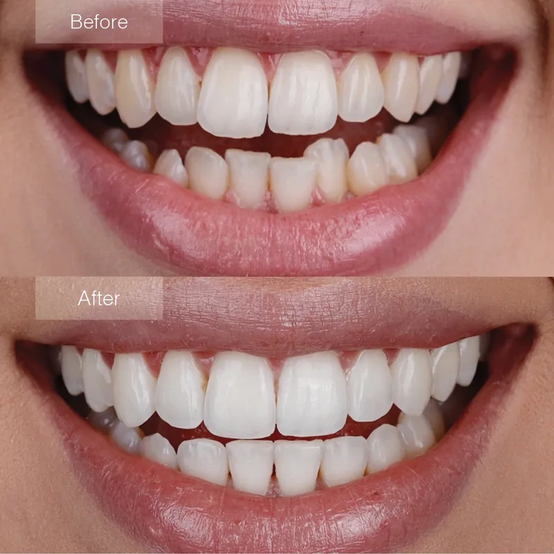 Before and after smile transformation with Invisalign