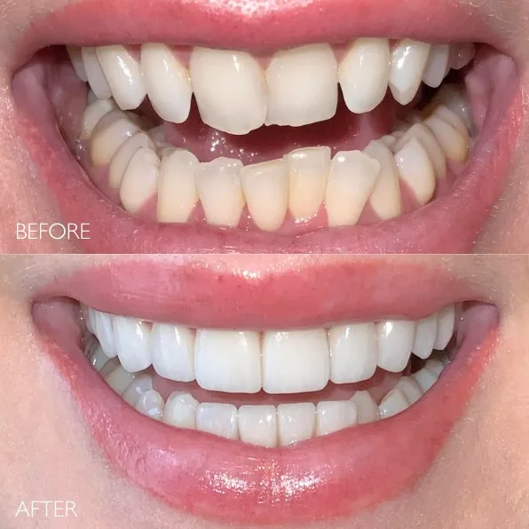 Before and after smile transformation with porcelain veneers