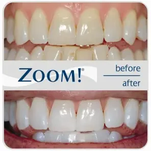 Before and after professional Zoom teeth whitening