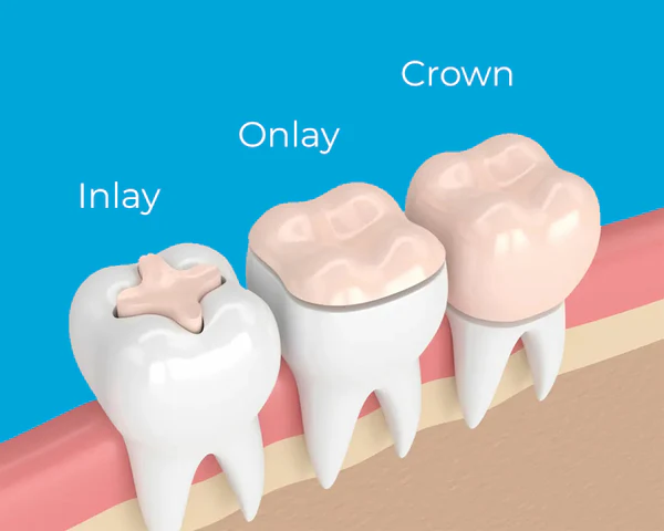 Illustration comparing dental inlay, onlay and crown restorations